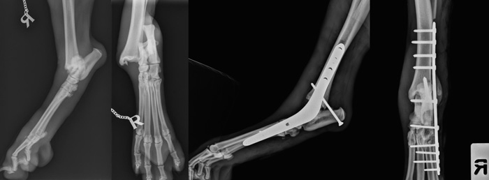 Pantarsal arthrodesis due to talocrural disruption / talar fracture 