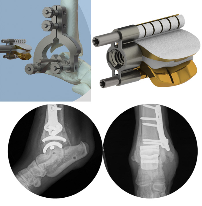 TATE Technology - Total Ankle Replacement