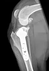TPLO lateral 168x240 1