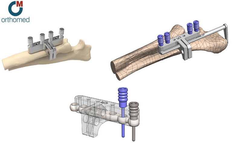 thumb-elbow-replacement-wear-vets