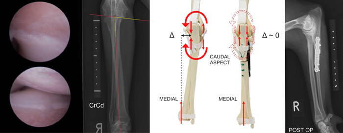 PAUL - Proximal Abducting Ulnar Osteotomy