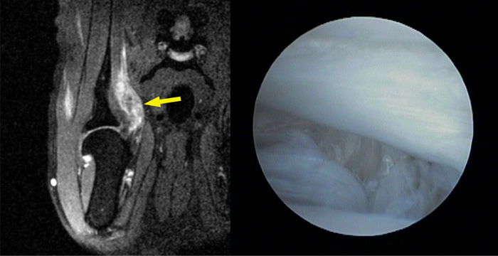 Tearing of the subscapularis tendon of insertion seen on MRI and arthroscopically.